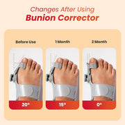 Adjustable Toe Straightener for Men & Women